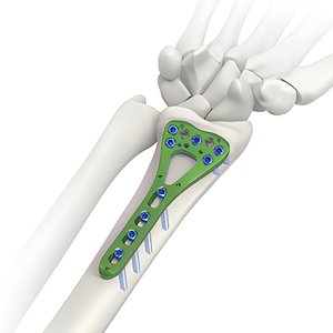 Orthopedic Trauma Implant Multi-axial Locking Plate