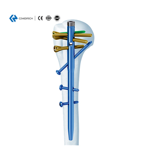 Reliable CZMEDITECH Multi-lock Humeral Intramedullary Nail CE Certified Class III Orthopedic Surgical Implants