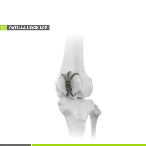 Orthopedic Trauma Bone Implant Patella Claw Plate