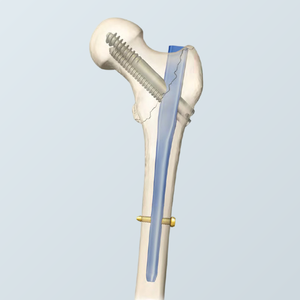 Interlocking Intramedullary Intertan Nail Titanium Proximal Femur