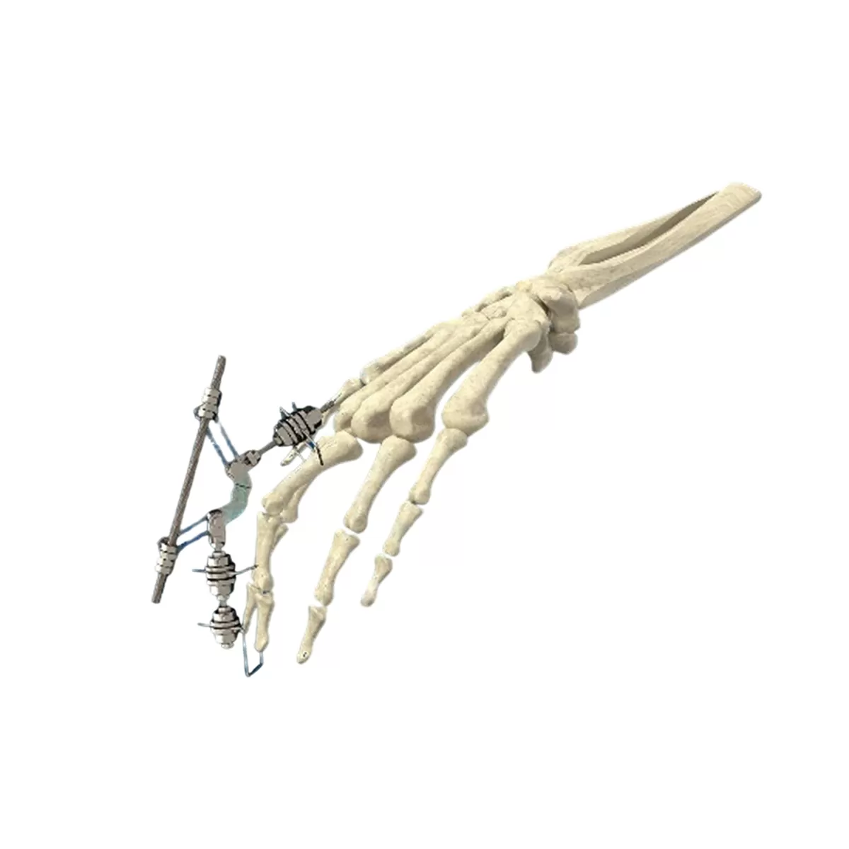 Phalanx External Fixator for Hand and Digit Trauma