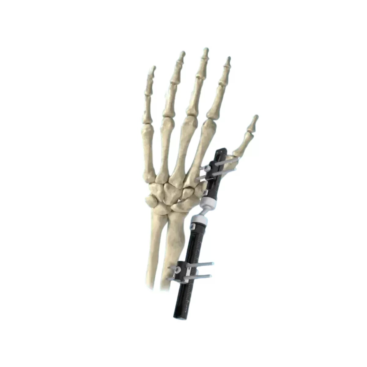 Wrist External Fixator for Distal Radius Fractures