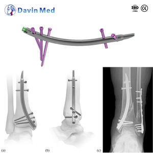 Sistema De Clavo Intramedular De Tibia Bloqueado OEM/ODM