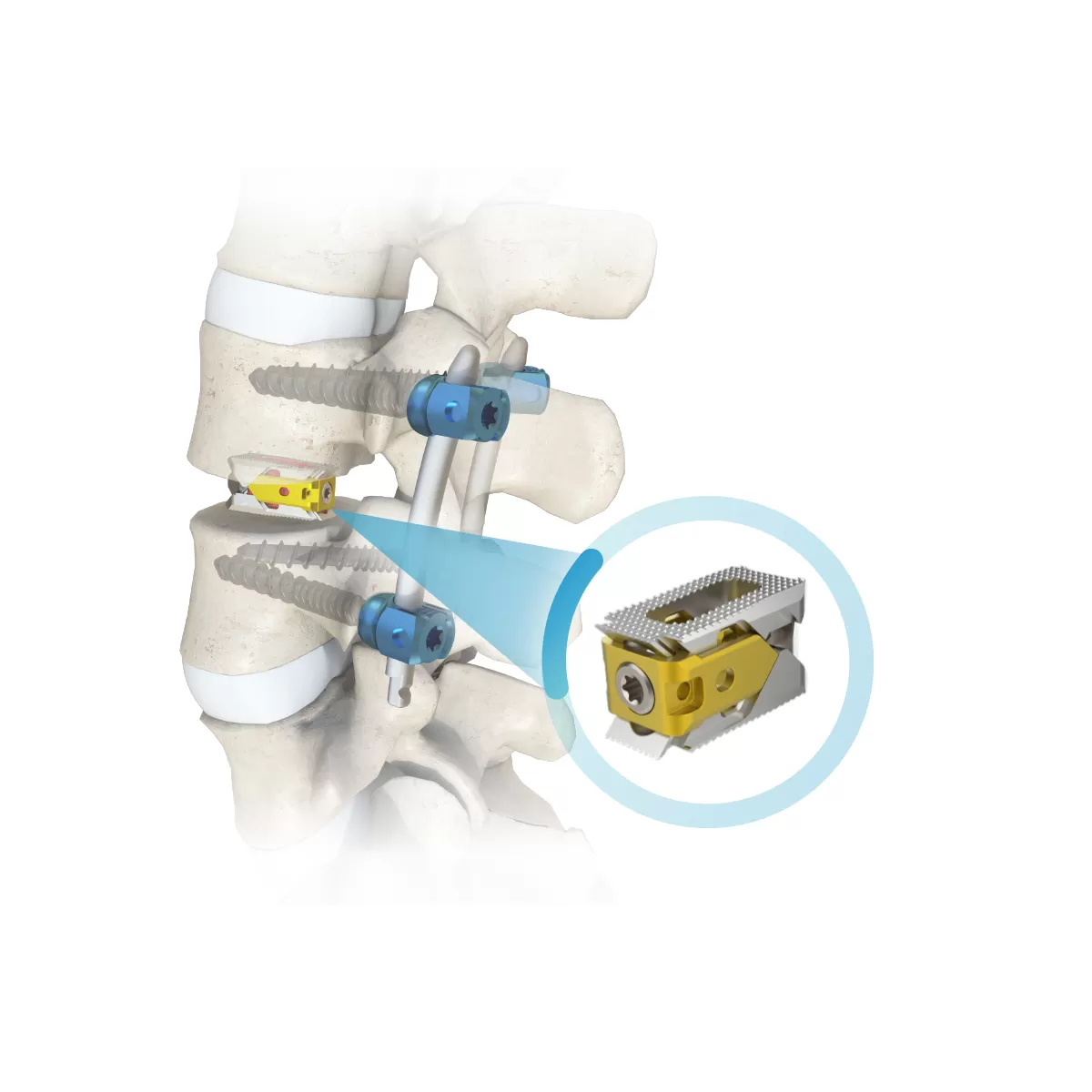 Expandable Interbody Fusion Cage