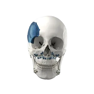 CMF implants - cranial plating and PEEK cranial repair