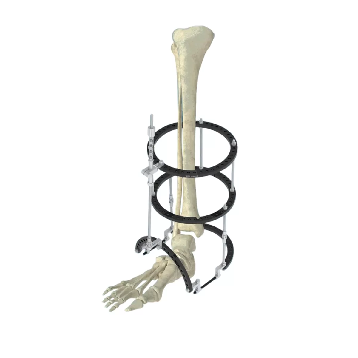 Ring-Type Multi-Function External Fixator System