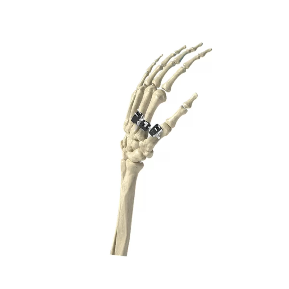 Mini External Fixator - Small Bone and Hand Fixation System