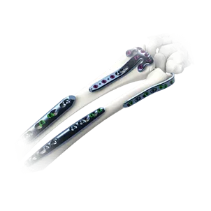 Trauma implants - locking plates and intramedullary nails