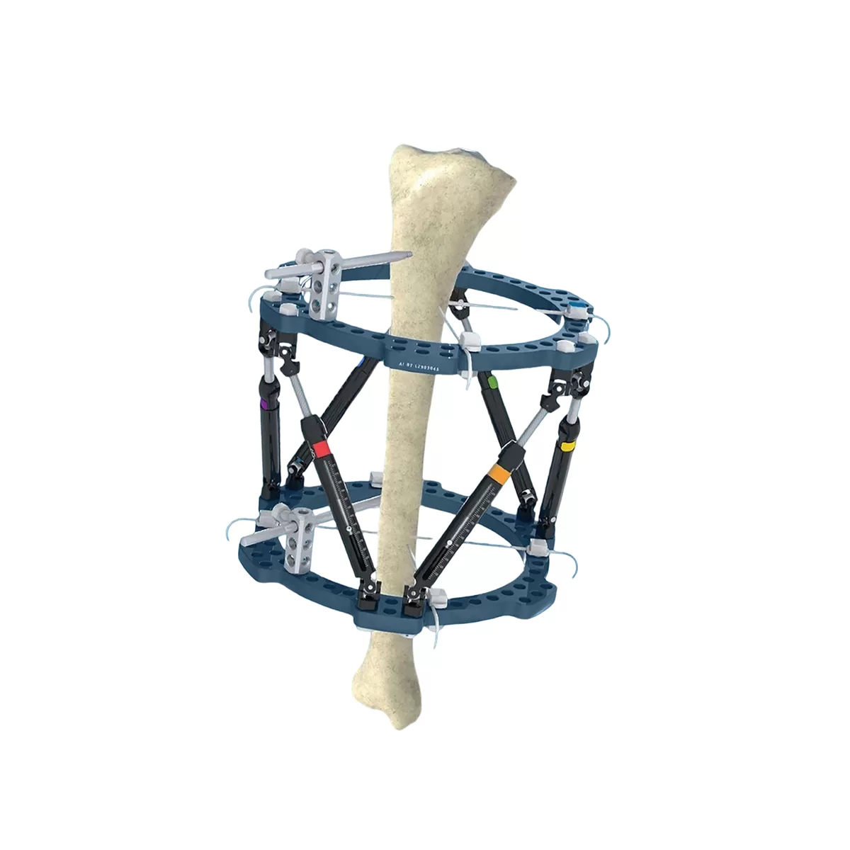 3D External Fixator - Multi-Planar Orthopedic Fixation System